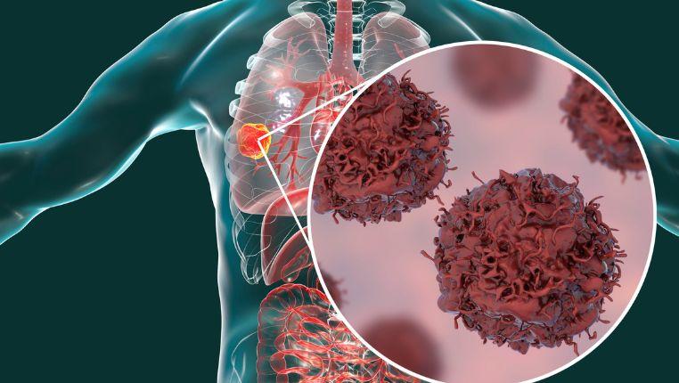 best lung cancer specialist in india